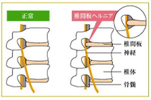 椎間板ヘルニア