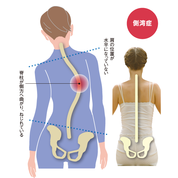 側湾症症状